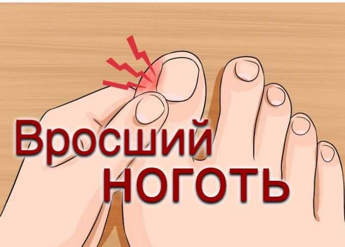 Грибок ногтей на ногах и руках: причины, первые признаки, основные симптомы. лечение онихомикоза в москве