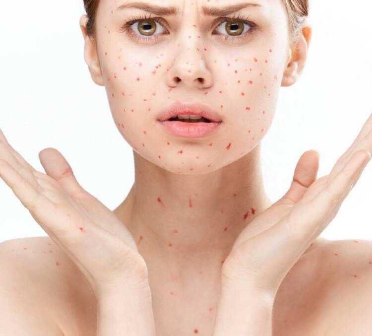 Прыщи на лице (акне) – причины появления, профилактика и методы борьбы с угревой сыпью