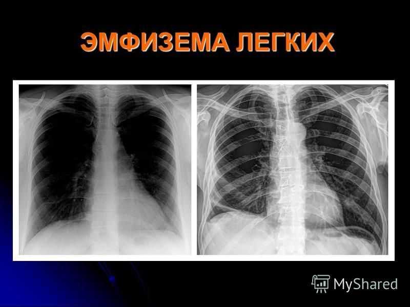 Глава 20. эмфизема лёгких