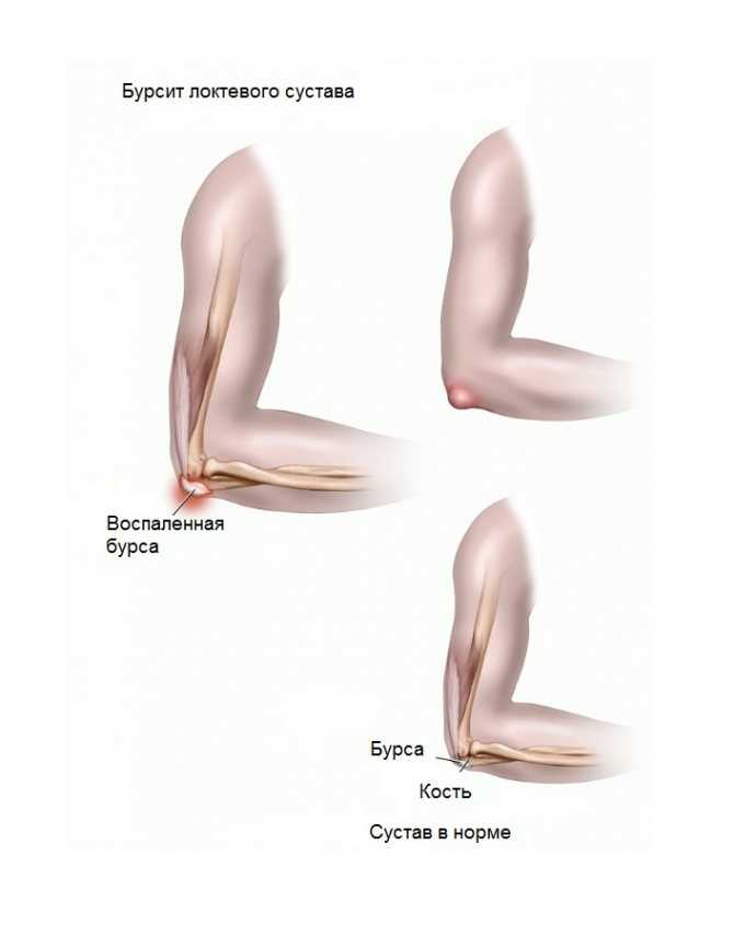 Лечение бурсита коленного сустава в киеве