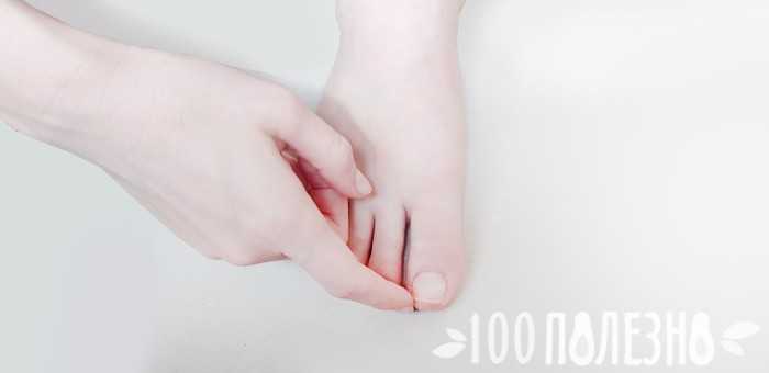 Вросший ноготь. причины, симптомы, диагностика и лечение вросшего ногтя.