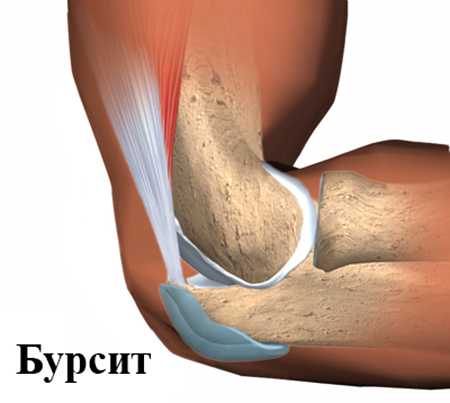 Бурсит коленного сустава лечение в киеве – клинике 42 года