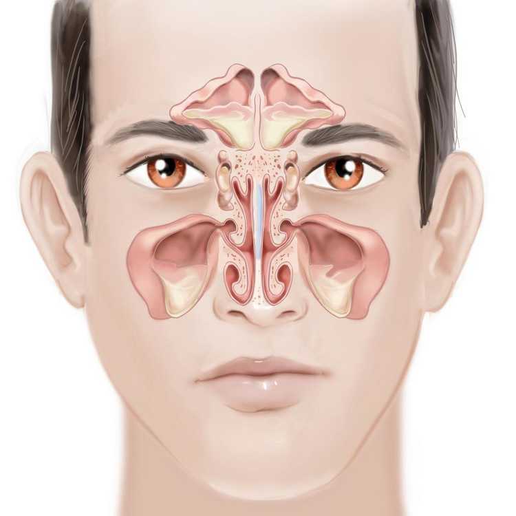 Синусит – воспаление носовых пазух. причины, симптомы, методы диагностики и лечения синусита